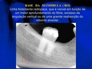 BASE DA MANDÍBULA ( RO)
Linha fortemente radiopaca, que é visível em função de
um maior aprofundamento do filme, excesso de
angulação vertical ou de uma grande reabsorção do
rebordo alveolar.
 