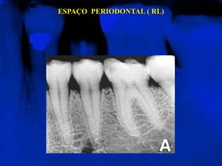 ESPAÇO PERIODONTAL ( RL)
 