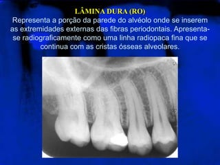 LÂMINA DURA (RO)
Representa a porção da parede do alvéolo onde se inserem
as extremidades externas das fibras periodontais. Apresenta-
se radiograficamente como uma linha radiopaca fina que se
continua com as cristas ósseas alveolares.
 