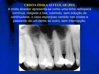 CRISTA ÓSSEA ALVEOLAR (RO)A crista alveolar apresenta-se como uma linha radiopaca contínua, delgada e lisa, cobrindo, sem solução de continuidade, o osso esponjoso contido nas cristas e passando de um dente ao outro, sem interrupção. 