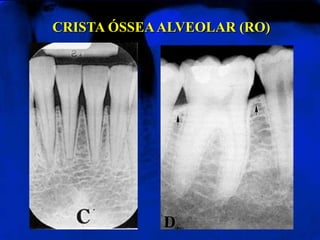 CRISTA ÓSSEA ALVEOLAR (RO)