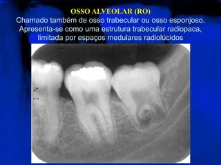 OSSO ALVEOLAR (RO)Chamado também de osso trabecular ou osso esponjoso. Apresenta-se como uma estrutura trabecular radiopaca, limitada por espaços medulares radiolúcidos