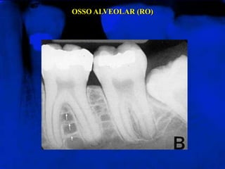 OSSO ALVEOLAR (RO)
