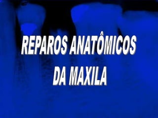 REPAROS ANATÔMICOS DA MAXILA