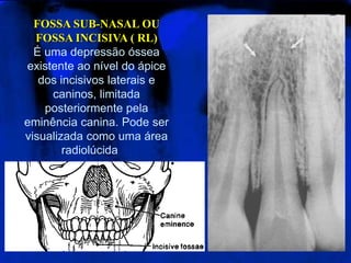 FOSSA SUB-NASAL OUFOSSA INCISIVA ( RL)É uma depressão óssea existente ao nível do ápice dos incisivos laterais e caninos, limitada posteriormente pela eminência canina. Pode ser visualizada como uma área radiolúcida 