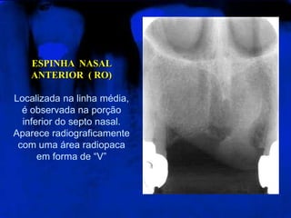 ESPINHA  NASAL  ANTERIOR  ( RO)Localizada na linha média, é observada na porção inferior do septo nasal. Aparece radiograficamente com uma área radiopaca em forma de “V”