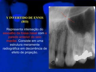 Y INVERTIDO DE ENNIS (RO)Representa interseção do assoalho da fossa nasal com aparede anterior do seio maxilar. Consiste em uma estrutura meramente radiográfica em decorrência de efeito de projeção.