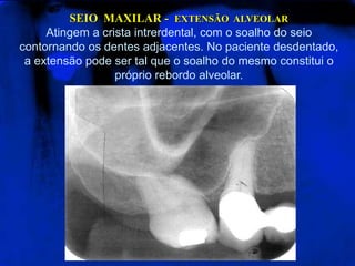 SEIO  MAXILAR -  EXTENSÃO  ALVEOLARAtingem a crista intrerdental, com o soalho do seio contornando os dentes adjacentes. No paciente desdentado, a extensão pode ser tal que o soalho do mesmo constitui o próprio rebordo alveolar. 