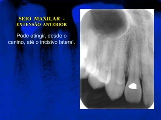SEIO  MAXILAR  -  EXTENSÃO  ANTERIORPode atingir, desde o canino, até o incisivo lateral.
