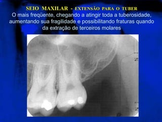 SEIO  MAXILAR  -  EXTENSÃO  PARA  O  TUBERO mais freqüente, chegando a atingir toda a tuberosidade, aumentando sua fragilidade e possibilitando fraturas quando da extração de terceiros molares