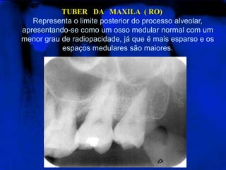 TUBER   DA   MAXILA  ( RO)Representa o limite posterior do processo alveolar, apresentando-se como um osso medular normal com um menor grau de radiopacidade, já que é mais esparso e os espaços medulares são maiores. 