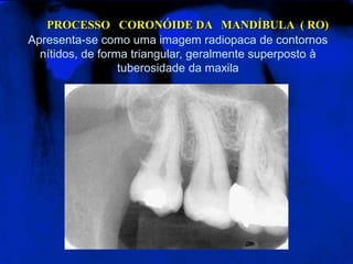 PROCESSO   CORONÓIDE DA   MANDÍBULA  ( RO)Apresenta-se como uma imagem radiopaca de contornos nítidos, de forma triangular, geralmente superposto à tuberosidade da maxila 