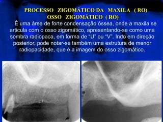 PROCESSO   ZIGOMÁTICO DA   MAXILA   ( RO)  OSSO   ZIGOMÁTICO  ( RO)É uma área de forte condensação óssea, onde a maxila se articula com o osso zigomático, apresentando-se como uma sombra radiopaca, em forma de “U” ou “V”. Indo em direção posterior, pode notar-se também uma estrutura de menor radiopacidade, que é a imagem do osso zigomático. 