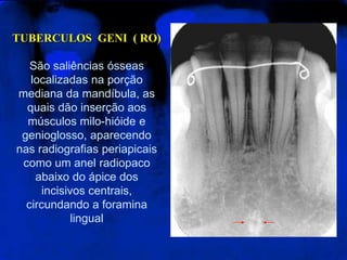 TUBERCULOS  GENI  ( RO)São saliências ósseas localizadas na porção mediana da mandíbula, as quais dão inserção aos músculos milo-hióide e genioglosso, aparecendo nas radiografias periapicais como um anel radiopaco abaixo do ápice dos incisivos centrais, circundando a foramina lingual