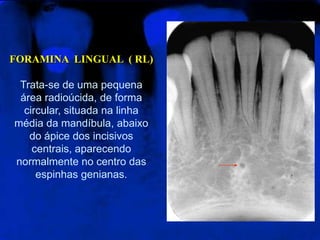 FORAMINA  LINGUAL  ( RL)Trata-se de uma pequena área radioúcida, de forma circular, situada na linha média da mandíbula, abaixo do ápice dos incisivos centrais, aparecendo normalmente no centro das espinhas genianas. 