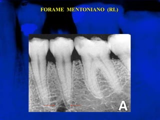 FORAME  MENTONIANO  (RL)
