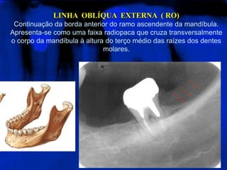 LINHA  OBLÍQUA  EXTERNA  ( RO)Continuação da borda anterior do ramo ascendente da mandíbula. Apresenta-se como uma faixa radiopaca que cruza transversalmente o corpo da mandíbula à altura do terço médio das raízes dos dentes molares. 