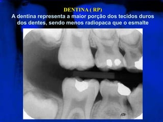 DENTINA ( RP)A dentina representa a maior porção dos tecidos duros dos dentes, sendo menos radiopaca que o esmalte