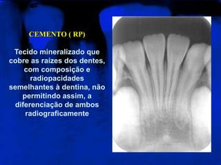 CEMENTO ( RP)Tecido mineralizado que cobre as raízes dos dentes, com composição e radiopacidades semelhantes à dentina, não permitindo assim, a diferenciação de ambos radiograficamente