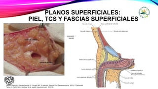 PLANOS SUPERFICIALES:
PIEL, TCS Y FASCIAS SUPERFICIALES
TCS – constituido estratos Impropiamente
denominados fascias.
Camper  estructura areolar- extensión
desde pared abdominal hacia pene,
escroto, periné, muslo y glúteos
Profunda – Scarpa tejido grasofibroso
de pared abdominal hacia pene ();
escroto y Periné
Fascia innominada – adherida
aponeurosis superficial – oblicuo mayor
Parrilla Paricio P, Landa García JI. Cirugía AEC 2ᵃ edición. Madrid: Ed. Panamericana. 2010. F.Carbonell
Tatay. X. Feliu Palá. Hernias de la región inguinocrural: 203-18.
 