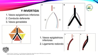 Y INVERTIDA
1. Vasos epigástricos inferiores
2. Conducto deferente
3. Vasos gonadales
Furtado M, Claus C, Cavazzola T L, et al. Systematization of laparoscopic inguinal hernia repair (TAPP) based on a new anatomical
concept: inverted Y and five triangles. ABCD Arq Bras Cir Dig.2019;32(1):e1426.
1. Vasos epigástricos
inferiores
2. Ligamento redondo
 