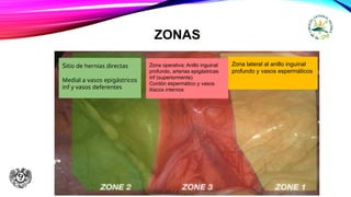 ZONAS
Zona lateral al anillo inguinal
profundo y vasos espermáticos
Zona operativa: Anillo inguinal
profundo, arterias epigàstricas
inf (superiormente)
Cordón espermático y vasos
ilíacos internos
Sitio de hernias directas
Medial a vasos epigástricos
inf y vasos deferentes
 