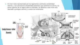  El nivel I está representado por los ligamentos cardinales (estabilidad
lateral), y los uterosacros (estabilidad posterior) que sostienen el cérvix y la
parte superior de la vagina sobre el elevador. Un defecto a este nivel está
asociado a prolapso uterino y a veces con enterocele
 