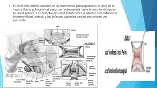  El nivel II de sostén depende de las inserciones paravaginales a lo largo de la
vagina (fascia pubocervical y septum rectovaginal) hasta el arco tendinoso de
la fascia pélvica. Los defectos del nivel II anteriores se asocian con cistocele o
hipermovilidad uretral, y los defectos vaginales medios posteriores con
rectocele.
 