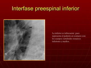 Interfase preespinal inferior La inferior es infrecuente  pues representa el pulmón en contacto con los cuerpos vertebrale...