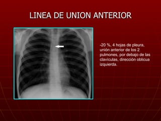 LINEA DE UNION ANTERIOR -20 %, 4 hojas de pleura, unión anterior de los 2 pulmones, por debajo de las clavículas, direcció...