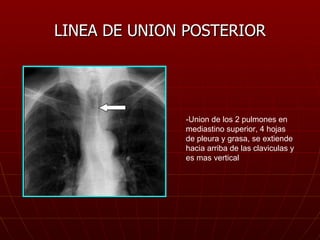 LINEA DE UNION POSTERIOR -Union de los 2 pulmones en mediastino superior, 4 hojas de pleura y grasa, se extiende hacia arr...