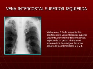 VENA INTERCOSTAL SUPERIOR IZQUIERDA Visible en el 5 % de los pacientes, interfase de la vens intercostal superior izquierd...