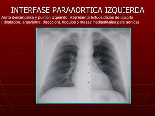 INTERFASE PARAAORTICA IZQUIERDA Aorta descendente y pulmon izquierdo. Representa tortuosidades de la aorta ( dilatacion, a...