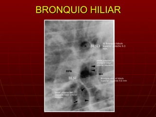 BRONQUIO HILIAR BLSD BLSI ® Bronquio lobulo superior derecho 9.3 mm. Bronquio para el lobulo superior izquierdo 9.6 mm par...