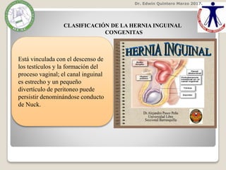 Dr. Edwin Quintero Marzo 2017.
CLASIFICACIÓN DE LA HERNIA INGUINAL
CONGENITAS
Está vinculada con el descenso de
los testículos y la formación del
proceso vaginal; el canal inguinal
es estrecho y un pequeño
divertículo de peritoneo puede
persistir denominándose conducto
de Nuck.
 