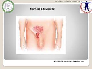 Dr. Edwin Quintero Marzo 2017.
Fernando Carbonell Tatay 1era Edición 2001
Hernias adquiridas
 