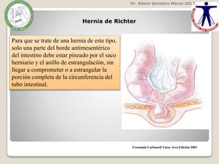 Dr. Edwin Quintero Marzo 2017.
Fernando Carbonell Tatay 1era Edición 2001
Hernia de Richter
Para que se trate de una hernia de este tipo,
solo una parte del borde antimesentérico
del intestino debe estar pinzado por el saco
herniario y el anillo de estrangulación, sin
llegar a comprometer o a estrangular la
porción completa de la circunferencia del
tubo intestinal.
 