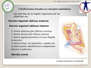 Dr. Edwin Quintero Marzo 2017.
Clasificaciones basadas en conceptos anatómicos
Las hernias de la región inguinocrural se
clasifican en:
Hernia inguinal oblicua externa
Hernia inguinal oblicua interna
1. hernia indirecta (por oblicua externa).
2. hernia directa (por oblicua interna)
3. hernia inguinoescrotal (si el saco llegaba
al escroto)
4. hernia mixta, «en pantalón», cuando tras
la intervención, identificamos componentes
directos e indirectos.
Fernando Carbonell Tatay 1era Edición 2001
Hernia crural
 