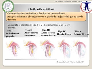 Dr. Edwin Quintero Marzo 2017.
Fernando Carbonell Tatay 1era Edición 2001
Clasificación de Gilbert
Cuenta criterios anatómicos y funcionales que establece
peroperatoriamente el cirujano (con el grado de subjetividad que se pueda
derivar).
Contempla V tipos: las del tipo I, II y III son indirectas y las IV y V,
directas.
Tipo I
Anillo interno
pequeño
Tipo II
Anillo interno
aumentado
Tipo III
Anillo interno
de mas de 4cm
Tipo IV
Hernia directa
Tipo V
Defecto directo
 