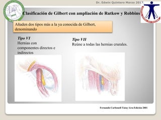 Dr. Edwin Quintero Marzo 2017.
Fernando Carbonell Tatay 1era Edición 2001
Clasificación de Gilbert con ampliación de Rutkow y Robbins
Añaden dos tipos más a la ya conocida de Gilbert,
denominando
Tipo VI
Hernias con
componentes directos e
indirectos
Tipo VII
Reúne a todas las hernias crurales.
 