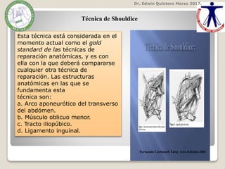 Esta técnica está considerada en el
momento actual como el gold
standard de las técnicas de
reparación anatómicas, y es con
ella con la que deberá compararse
cualquier otra técnica de
reparación. Las estructuras
anatómicas en las que se
fundamenta esta
técnica son:
a. Arco aponeurótico del transverso
del abdómen.
b. Músculo oblicuo menor.
c. Tracto iliopúbico.
d. Ligamento inguinal.
Dr. Edwin Quintero Marzo 2017.
Fernando Carbonell Tatay 1era Edición 2001
Técnica de Shouldice
 