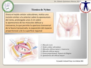 Dr. Edwin Quintero Marzo 2017.
Fernando Carbonell Tatay 1era Edición 2001
Técnica de Nyhus
Diseca el tejido celular subcutáneo, realiza una
incisión similar a la anterior sobre la aponeurosis
del recto, prolongada unos 2 cm sobre
la aponeurosis de los músculos oblicuo y
transverso, lo que permite la apertura transversal
de la fascia transversalis, la exposición del espacio
preperitoneal y de la superficie inguinal
1. Músculo recto
2. Tejido celular subcutáneo
3. Músculos oblicuo menor y transverso
4. Músculo oblicuo mayor
5. Grasa preperitoneal: Espacio de Bogros
6. Aponeurosis del oblicuo mayor
1
2
3
4
5
6
 