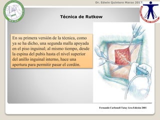 Dr. Edwin Quintero Marzo 2017.
Fernando Carbonell Tatay 1era Edición 2001
Técnica de Rutkow
En su primera versión de la técnica, como
ya se ha dicho, una segunda malla apoyada
en el piso inguinal; al mismo tiempo, desde
la espina del pubis hasta el nivel superior
del anillo inguinal interno, hace una
apertura para permitir pasar el cordón.
 