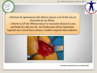 Dr. Edwin Quintero Marzo 2017.
Fernando Carbonell Tatay 1era Edición 2001
-Abertura de aponeurosis del oblicuo mayor a nivel del osis en
dirección de sus fibras.
- Abierta la AP del oblicuo mayor es necesario disecar la cara
profunda de cada uno de sus bordes para ubicar ligamento
inguinal arco crural hacia afuera y tendón conjunto hacia adentro.
 