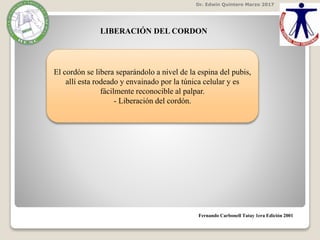LIBERACIÓN DEL CORDON
El cordón se libera separándolo a nivel de la espina del pubis,
allí esta rodeado y envainado por la túnica celular y es
fácilmente reconocible al palpar.
- Liberación del cordón.
Fernando Carbonell Tatay 1era Edición 2001
Dr. Edwin Quintero Marzo 2017
 