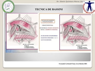Dr. Edwin Quintero Marzo 2017.
Fernando Carbonell Tatay 1era Edición 2001
TECNICA DE BASSINI
 