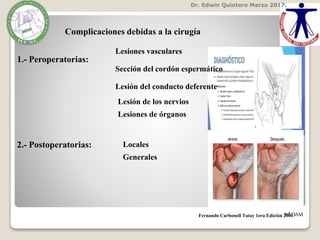Dr. Edwin Quintero Marzo 2017.
Fernando Carbonell Tatay 1era Edición 2001
Complicaciones debidas a la cirugía
1.- Peroperatorias:
2.- Postoperatorias:
Lesiones vasculares
Sección del cordón espermático
Lesión del conducto deferente
Lesión de los nervios
Lesiones de órganos
Locales
Generales
 