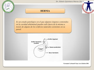 Dr. Edwin Quintero Marzo 2017.
HERNIA
Es un estado patológico en el que algunos órganos contenidos
en la cavidad abdominal pueden salir fuera de la misma a
través de alguno de los orificios naturales existentes en su
pared.
Fernando Carbonell Tatay 1era Edición 2001
 