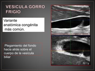 Variante
anatómica congénita
más común.
Plegamiento del fondo
hacia atrás sobre el
cuerpo de la vesícula
biliar
 