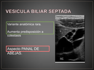 Variante anatómica rara.
Aumenta predisposición a
colestasis
Aspecto PANAL DE
ABEJAS.
 